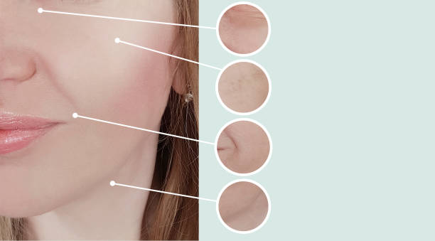 istock female wrinkles before and after pigmentation 1135123004