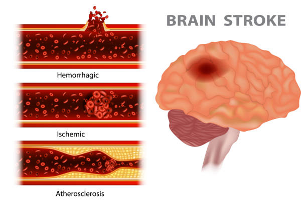 Types of stroke: Atherosclerosis, Ischemic, Hemorrhagic Types of stroke: Atherosclerosis, Ischemic, Hemorrhagic stroke illness illustrations stock illustrations