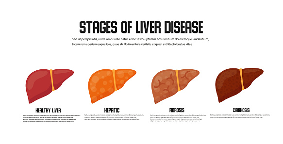 Stages of liver damage concept. Vector icon