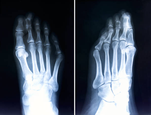 radiografía de los dedos de los pies. radiografía con dedos deformes. hallux valgus - deformed fotografías e imágenes de stock
