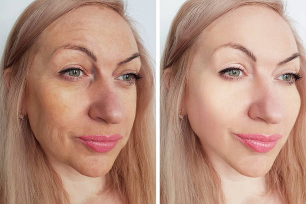 istock woman wrinkles face before and after procedures 1135486181