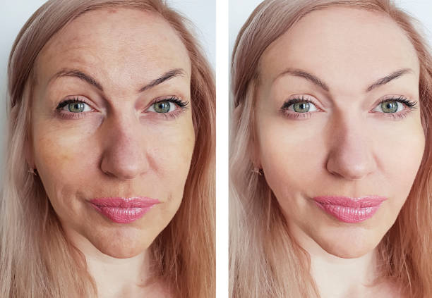 istock woman wrinkles face before and after procedures 1135501830