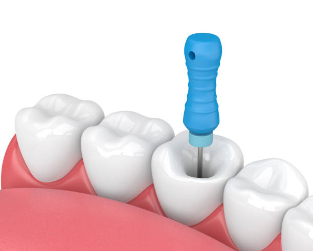 istock 3d render of tooth with endodontic file in jaw 1135523005