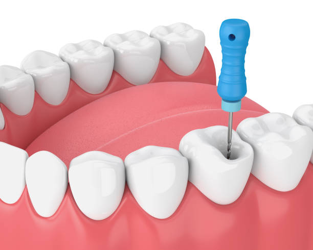 istock 3d render of tooth with endodontic file in jaw 1135523007