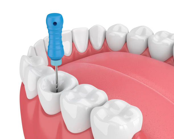 istock 3d render of tooth with endodontic file in jaw 1135523009