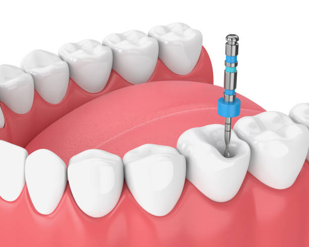istock 3d render of tooth with endodontic file in jaw 1135523011