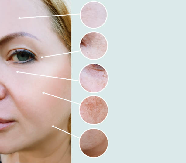 istock female wrinkles before and after pigmentation 1135589573