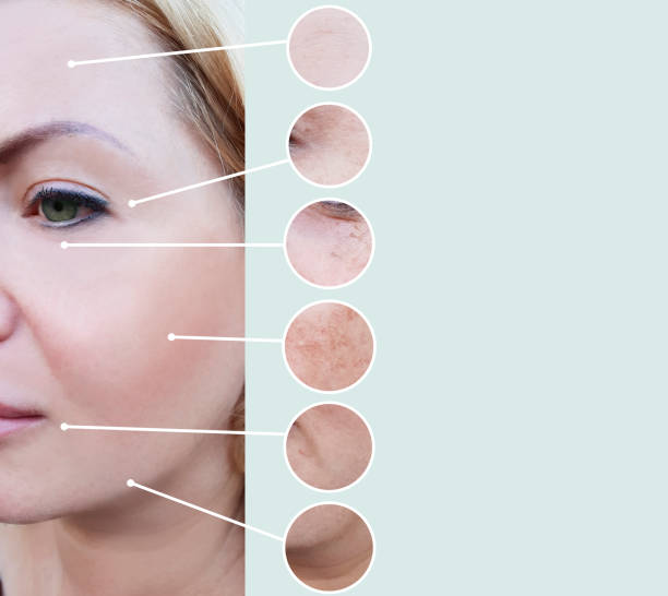 istock female wrinkles before and after pigmentation 1135596864