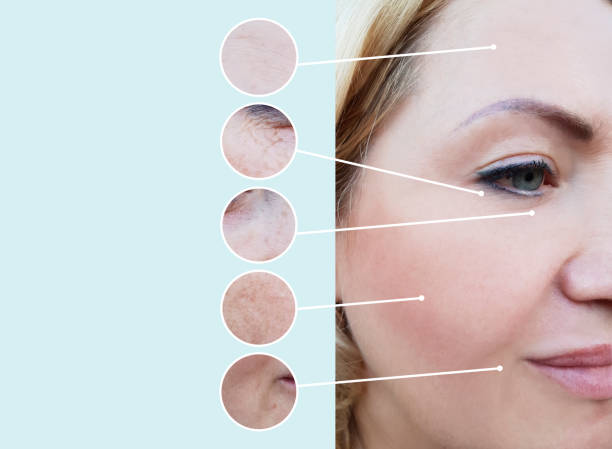 istock female wrinkles before and after the procedures 1135598818