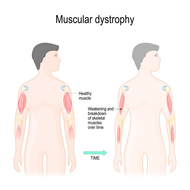 Muscular dystrophy Muscular dystrophy is a muscle diseases that results in weakening and breakdown of skeletal muscles over time. Vector illustration for educational, science and medical use atrophy stock illustrations