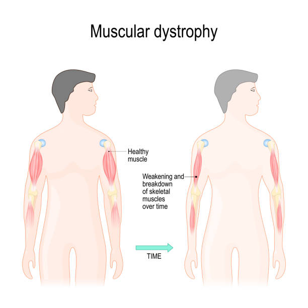 Through Which Mechanism Is Duchenne Muscular Dystrophy Acquired Duchenne Muscular Dystrophy Diagram