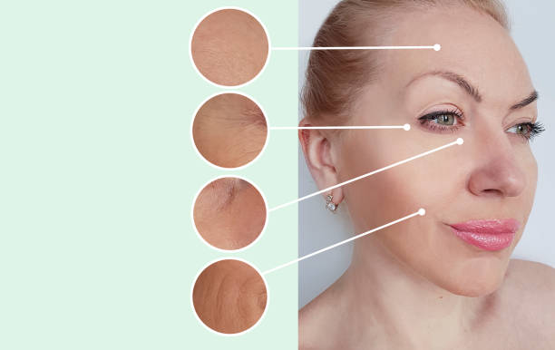 istock woman wrinkles before and after collage procedures 1135823537