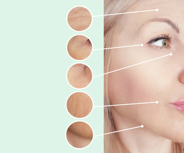 istock woman wrinkles before and after collage procedures 1135831861