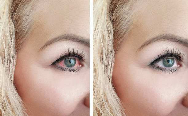 istock woman red eye before and after the procedures 1135942915