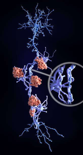 istock Neuron affected by multiple sclerosis. The oligodendrocytes that build up the myelin sheath are attacked by microglia cells. 1135943678