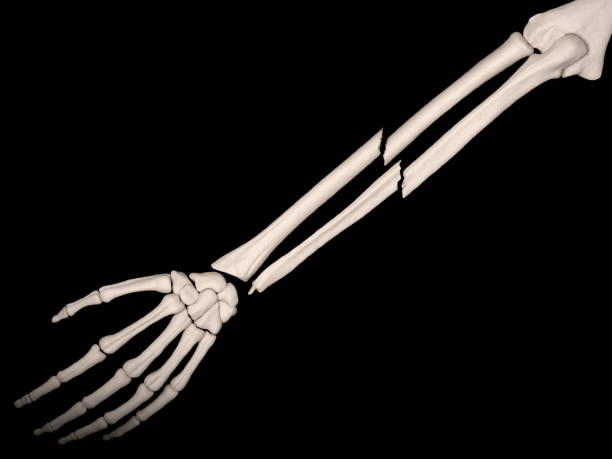 istock Radius and ulna fracture 1135947900