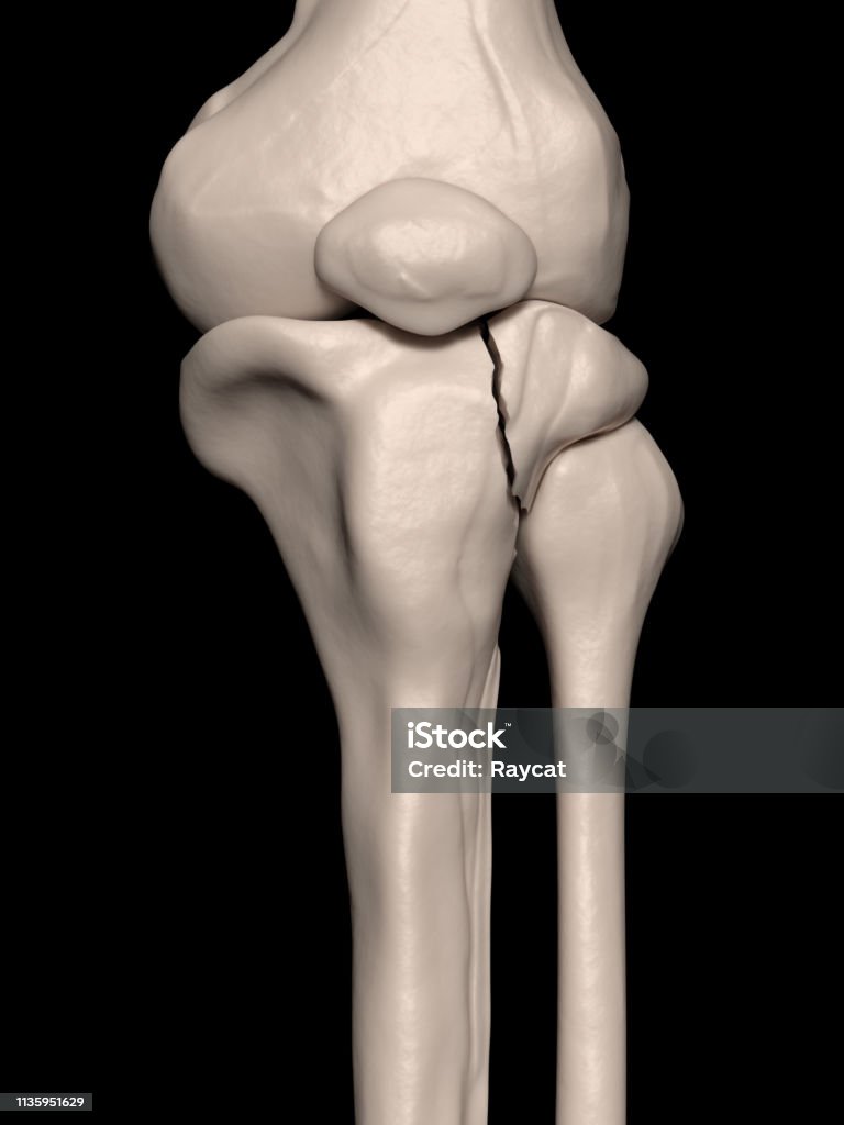 Tibia Proksimal Proximal Tibia Fraktur Dataran Tinggi Tibial Foto Stok - Unduh Gambar ...