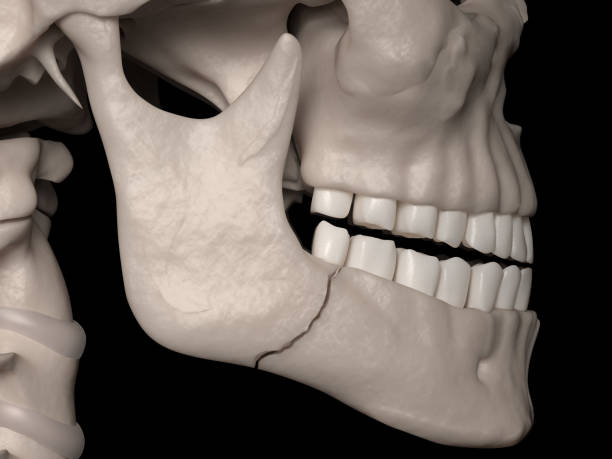 Simple fracture of the Angle (mandibular fracture) stock photo