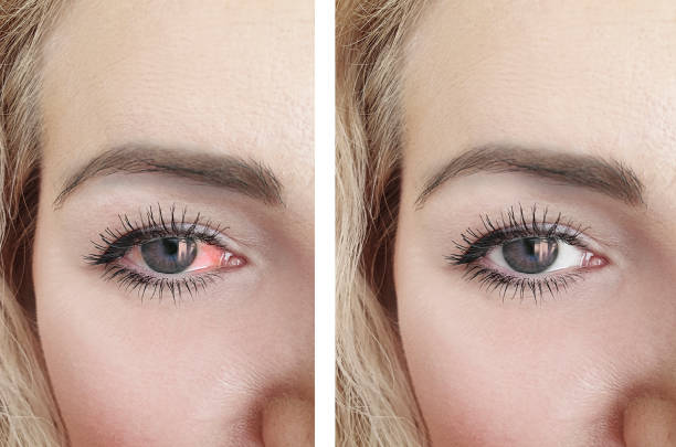 istock woman red eye before and after procedures 1135965175
