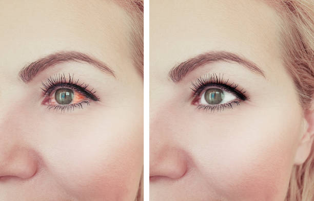 istock woman red eye before and after procedures 1135965191