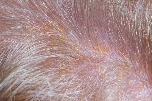 Yellow dandruff scales on the hair. Seborrhea. Macro photography to show the disease.