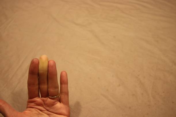 istock Raynaud’s Syndrome Phenomena Adult Hand 1136089103