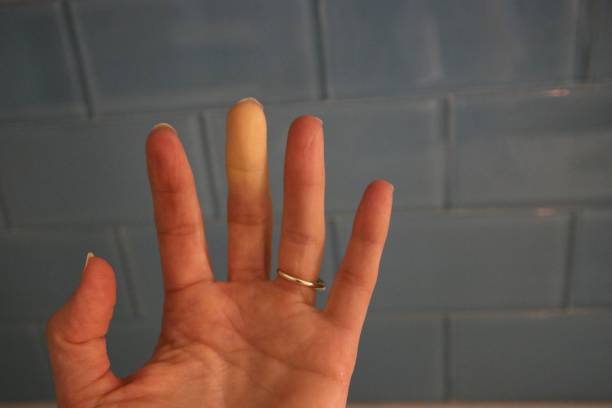 Raynaud’s Syndrome Phenomena Adult Hand Raynaud’s Syndrome Phenomena Adult Hand natural phenomenon stock pictures, royalty-free photos & images