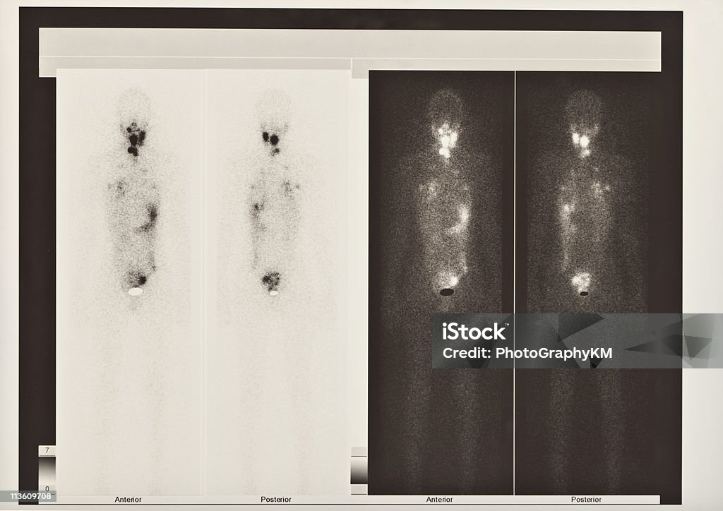 Scintigraphy Scanner de la thyroïde et cancer des poumons - Photo de Contamination radioactive libre de droits