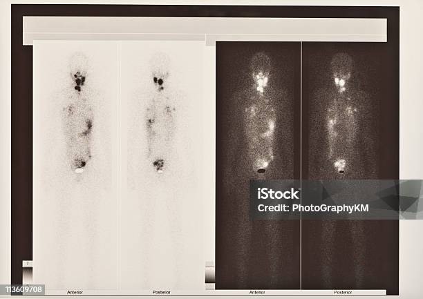 Scintigrafia Ossea Della Tiroide E Carcinoma Polmonare - Fotografie stock e altre immagini di Contaminazione radioattiva