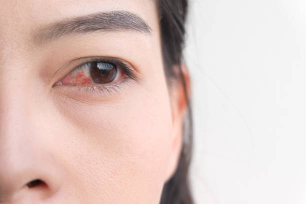 red eye. conjunctivitis or irritation of sensitive eyes. stock photo