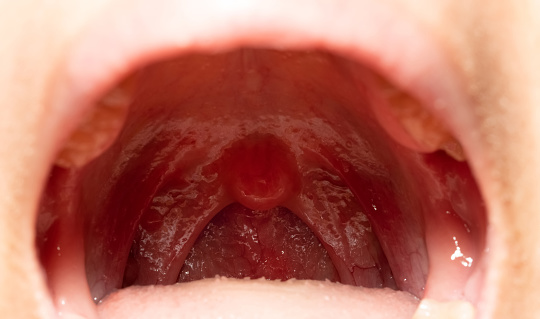 Sore throat with throat swollen. Closeup open mouth with posterior pharyngeal wall swelling and uvula and tonsil. Influenza follicles in the posterior pharyngeal wall. Upper respiratory tract.