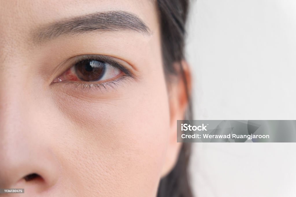 red eye. conjunctivitis or irritation of sensitive eyes. Dry Stock Photo