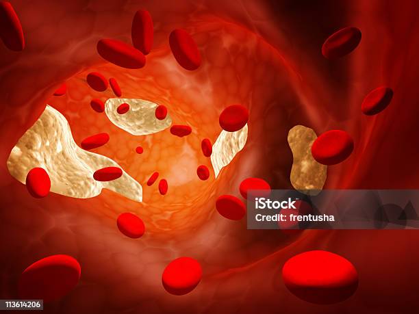 Aterosclerose - Fotografias de stock e mais imagens de Anatomia - Anatomia, Arteriosclerose, Artéria Coronária