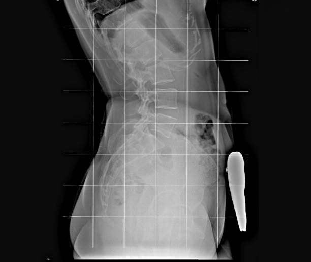 istock X-ray of the pelvis and spinal column, side view 1136158473