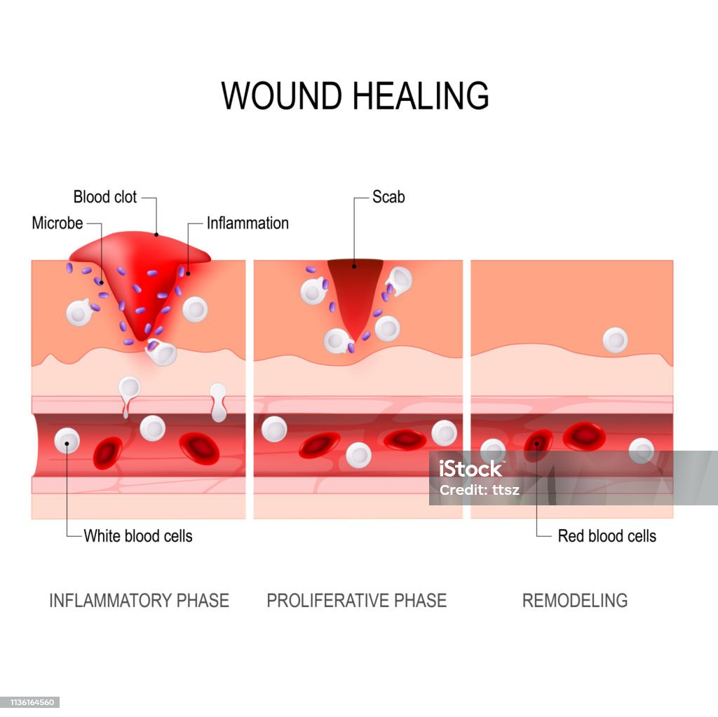 Wound Healing Process Tissue Injury And Inflammation Stock Illustration Wound Healing Process Tissue Injury And Inflammation Stock Illustration