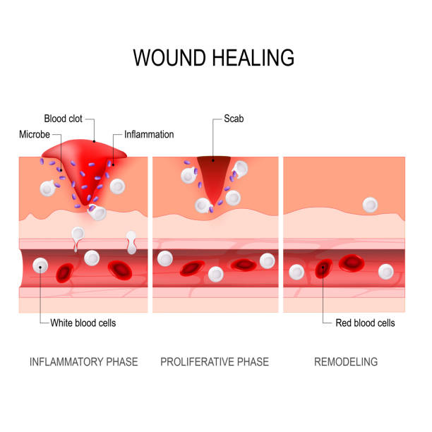 wound healing process. Tissue injury and inflammation wound healing process. Hemostasis, Inflammatory, Proliferative, Maturation and remodeling. Tissue injury and inflammation. Immune system. vector diagram for medical, educational and scientific use. skin inflammation stock illustrations