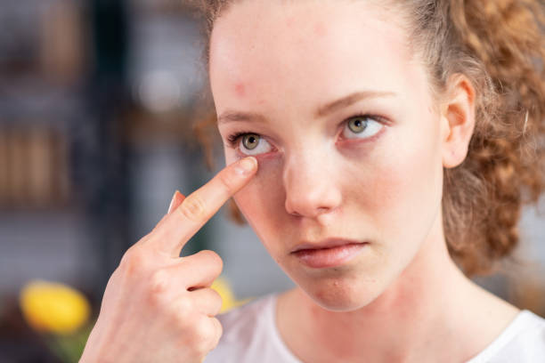 istock Unfortunate young lady with curly hair itching her eyelid 1136200328