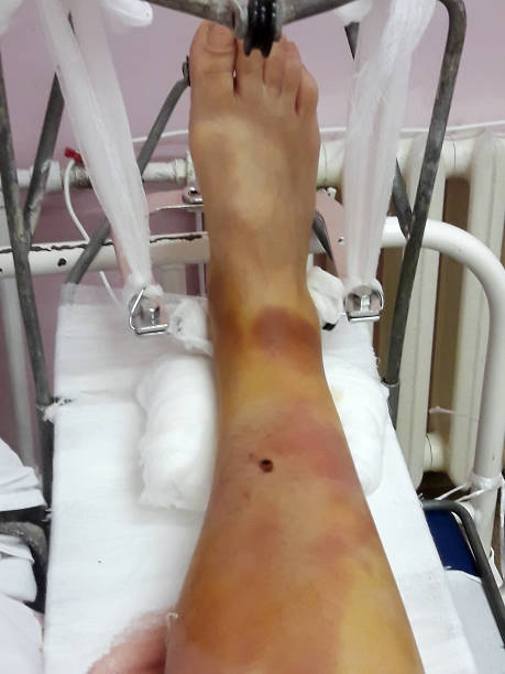 istock Open leg fracture, close-up. 1136210283