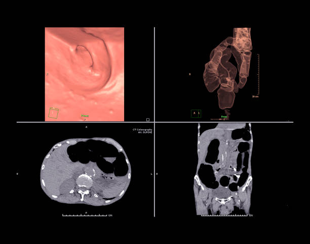 ct 식민지 화 또는 콜론 축 보기 vs 코로나 뷰 및 3d 렌더링 이미지를 화면의 ct 스캔. - descending colon 뉴스 사진 이미지