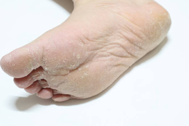 istock Athlete's foot, eczema, exotic foot. 1136290765