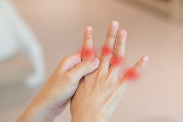 overuse hand problems. woman hand with red spot o fingers as suffer from carpal tunnel syndrome. the symptoms of tingling, numbness, weakness, or pain of the fingers and wrist. - osteoarthritis doctor medicine healthcare and medicine imagens e fotografias de stock