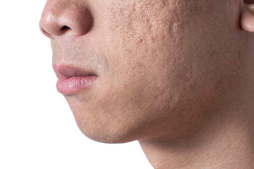El acné de cerca y las cicatrices en la cara del hombre asiático photo