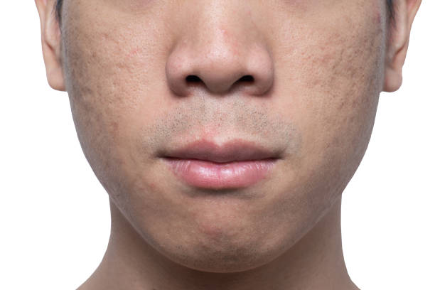 Close-up acne and scars on asian man face stock photo