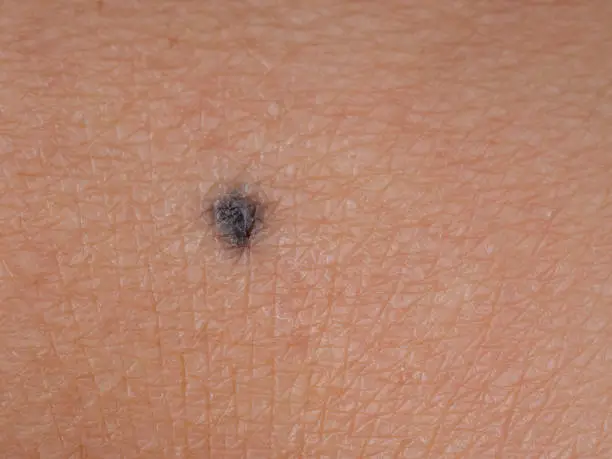 Photo of Dark colour Blue neuronevus mole aka dermal melanocytoma, a type of melanocytic nevus. Generally benign.