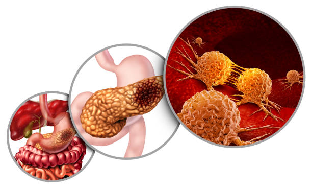 istock Pancreas Cancer Anatomy 1136507405