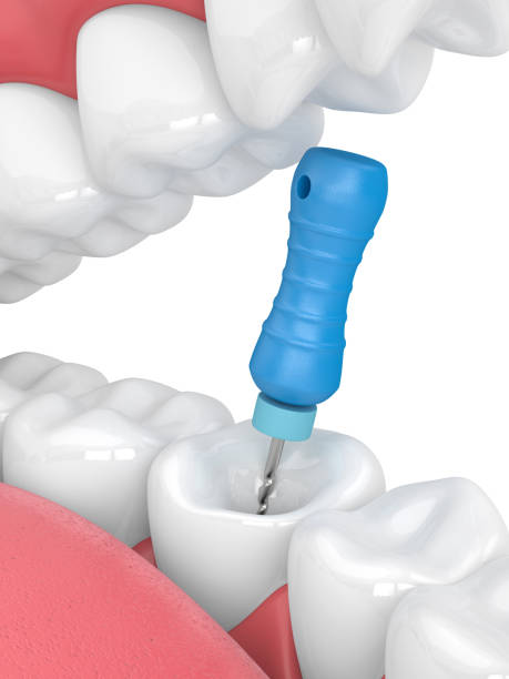 istock 3d render of tooth with endodontic file in jaw 1136514585