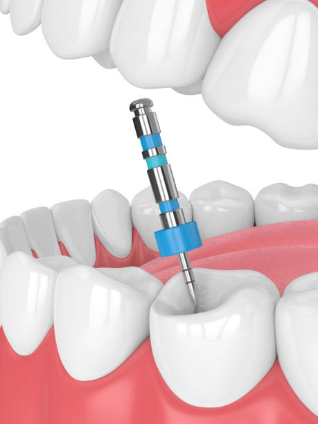 istock 3d render of tooth with endodontic file in jaw 1136514587