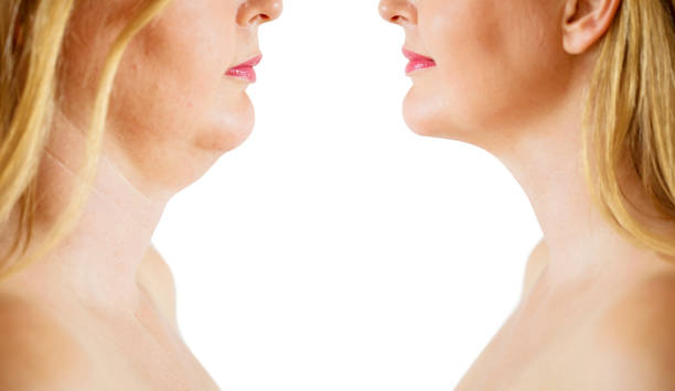 Double chin fat or dewlap correction, before and after Caucasian ethnicity middle aged woman before and after chin fat or dewlap correction before and after stock pictures, royalty-free photos & images