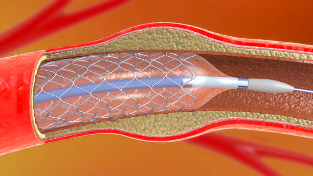 ilustración 3d de implantación de stent para apoyar la circulación sanguínea en los vasos sanguíneos - angioplasty fotografías e imágenes de stock