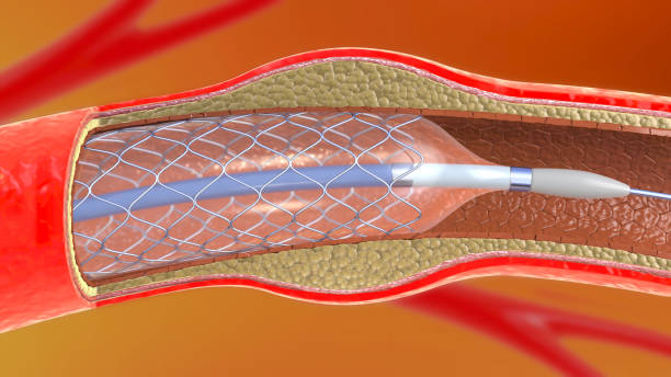 illustration 3d de l'implantation de stent pour soutenir la circulation sanguine dans les vaisseaux sanguins - angioplasty photos et images de collection